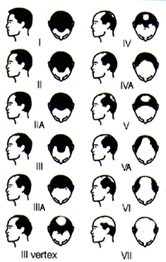 Alopecia/Calvicie
