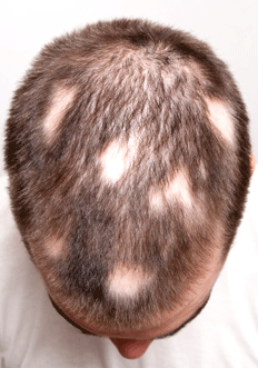 alopecia-areata