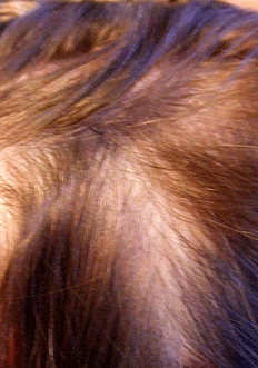 alopecia-areata